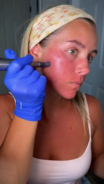 I wish I started Microneedling 💉 sooner because the results are TOO GOOD. ✨ 🤍🤏🏼 #microneedling #microneedlingbeforeandafter #microneedlingtherapy #beautytips #antiagingskincareroutine @WNP SKINCARE 