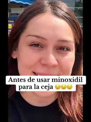 Minoxidil para la ceja 😍 #minoxidilresult #cejaspobladas #cejasbonitas #skincare #fypシ 