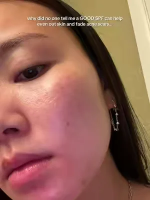 not to be dramatic but this spf changed my life…AND SKIN 😭 @SKIN1004 US  #sunprotection #acnescars #hyperpigmentation #acneproneskin #dealsforyoudays 