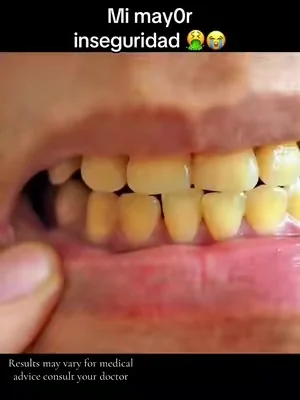 Si eres sensible a lo asqueroso no mires el video esto te saca hasta tus más sucios pecados entre los dientes #idwhitening #mouthwash #dealsforyoudays #summervives #tiktokshopcreatorpicks @Hismile US 