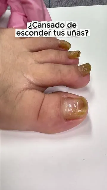 Mira el antes y el después 😱💅 Así cambian tus uñas con solo aplicar 2 veces al día. ¡Adiós uñas amarillas y gruesas! #DealsForYouDays #uñasfungus #tiktokshopstockup #fyp #fungaltoenails