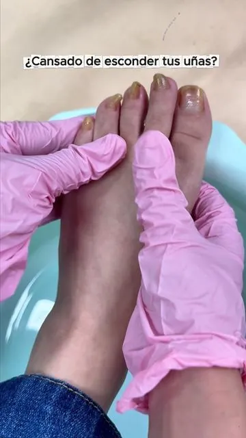 Mira el antes y el después 😱💅 Así cambian tus uñas con solo aplicar 2 veces al día. ¡Adiós uñas amarillas y gruesas! #DealsForYouDays #uñasfungus #tiktokshopstockup #fyp #fungaltoenails
