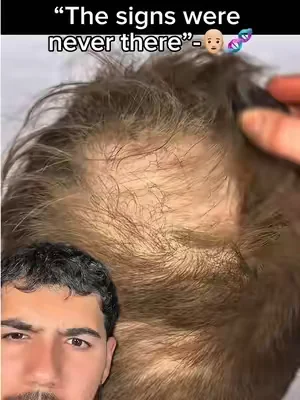 Balding for me was one of my biggest insecurities. So im doing everything i can to prevent it.👨🏼‍🦲🧬