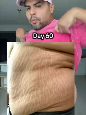 Day 60 of using Gopure stretch mark cream. I’m impressed with the results #gopure 
