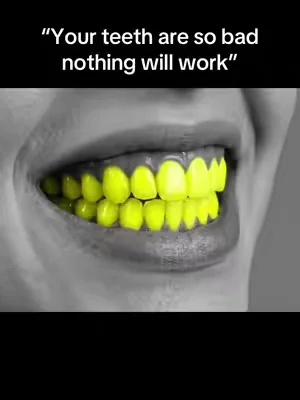 I was not expecting these results… 😳🦷‼️ ##yellowteeth##teethwhitening##teethwhiteningstrips##DealsForYouDays##summerwins