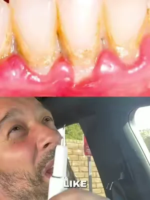 electric dental scraper, power tooth scraper, oral care gadget, plaque remover tool, teeth cleaning device, rechargeable dental tool, oral hygiene routine, coffee stain cleaning, dental care essentials, smart oral care, hygiene gadgets, everyday self care, clean teeth routine, TikTok oral care finds, dental tools #DealsForYouDays #oralcare #teethcleaning #dentalhygiene #SelfCare