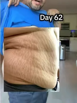 Day 62 of using Gopure stretch mark cream to remove stubborn stretch marks #gopure