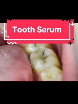 Your smile is the first thing people notice when they see you #teeth #decay #nanohydroxyapetite #remineralizing #hismile 