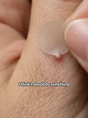#fyp #pimple #pimplepopping #SummerWins #tiktokshopdealsforyoudays 