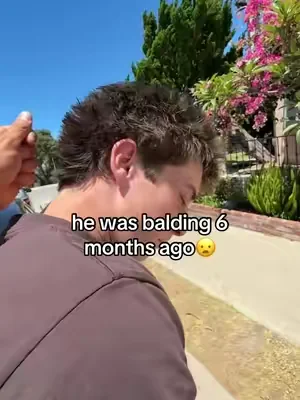 #bodywise #hairgrowth #balding #recedinghairline 