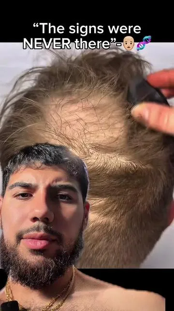 Take care of your hair, or plan that trip to turkey👨🏼‍🦲🧬