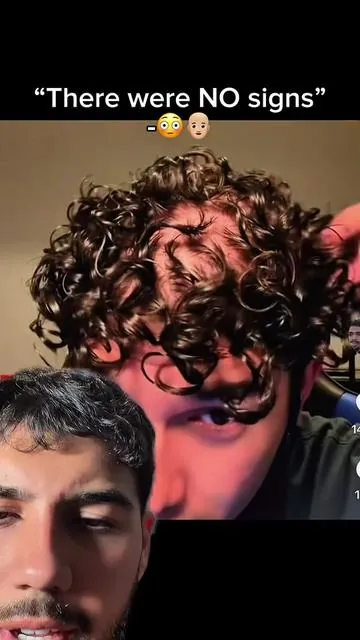 …… take care of your scalp health, genetics plays a role, but if you dont even try to help youre just cooked👨🏼‍🦲🧬