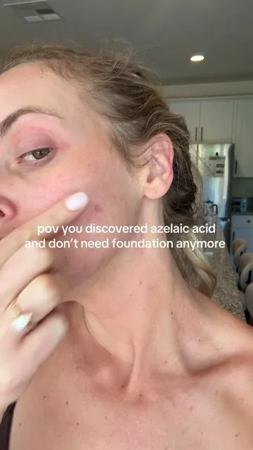 this has been going on since middle school!!!  #skin1004 #dealsforyoudays #acne #acnescars 