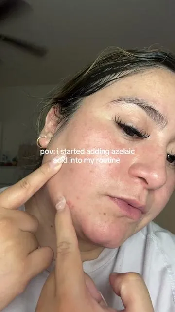 #skin1004 #azelaicacid #koreanskincare 
