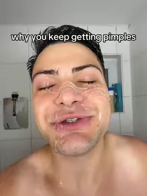 Once I started doing this, my pimples stopped coming back 🙏