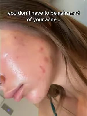 truly a life saver #acne #hormonalacne #skin #dealsforyoudays #clearstem 