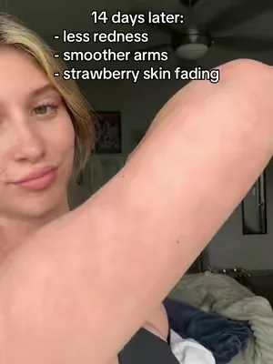 no more hiding my arms 🥲 #KP #strawberryskin #skintransformation #summerwins #dealsforyoudays 