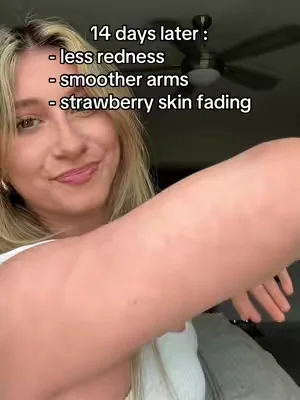 finally see results clearing my KP 🥲 #KP #strawberryskin #skintransformation #summerwins #dealsforyoudays 