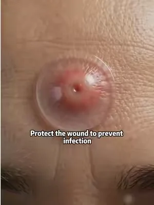 #fyp #pimple #pimplepopping #SummerWins #DealsForYouDays 