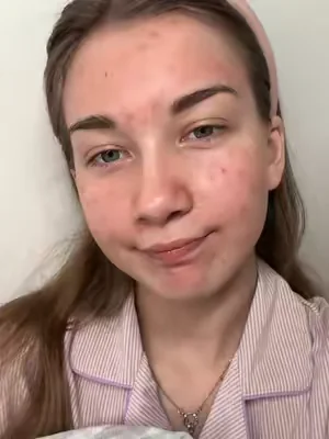 My acne transformation in 20 days 🤯 Grab it before it's gone #DealsForYouDays #acnetreatment #acne #skincare #drleodryinglotion 