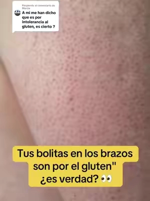 Respuesta a @Marcia  Tus bolitas en los brazos son por el gluten — ¿es verdad? Como Nurse Practitioner te aclaro: el gluten NO causa directamente la queratosis pilaris ("piel de gallina"). El matiz: en personas con celíaca o sensibilidad al gluten, el daño intestinal puede afectar la absorción de nutrientes como la vitamina A o las grasas buenas, y esa falta puede empeorar las bolitas — por eso algunos mejoran sin gluten y otros no notan nada. La ciencia aún lo debate; no hay vínculo comprobado en general. Ojo con la confusión más común: la KP se confunde con la dermatitis herpetiforme, que esa SÍ está ligada al gluten (pica e sale en ampollas) — la piel de gallina no pica así. Lo que de verdad causa la KP es la queratina, que tapa el folículo. Lo que ayuda a la textura es disolver ese tapón + humectar, por eso me gusta el Remedy KP (creado por dermatólogo): retinol, urea, ácido láctico y ceramidas. Con constancia, la textura se suaviza. Si estás embarazada, consulta por el retinol. Encuéntralo en el carrito 🛒  #QueratosisPilaris #PielDeGallina #TikTokShopCreatorPicks #CreatorSearchInsights #dealsforyoudays  
