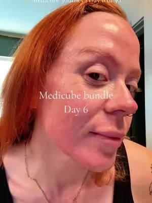 Day 6 ✨ It’s funny how the little changes start adding up. No overnight miracle… just consistently healthier-looking skin. I’ll keep sharing my honest updates every day! 🩷 #medicube #kbeauty #koreanskincare #skincare #dealsforyoudays 
