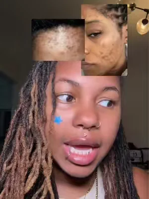 the skin changes have been crazyyy #hyperpigmentation #glutathione #acnescars #resultsmayvary 