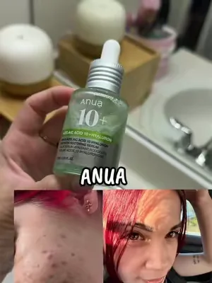 Esto no es un filtro, es mi piel después de usar este serum de Anua. Si tienes marcas de acné, rojeces o brotes, este serum con 10% de ácido azelaico ayuda a mejorar la apariencia de las manchas, calma la piel y la mantiene hidratada. Mira mi antes y después porque habla por sí solo #TikTokShopDealsforYouDays #DealsForYouDays #summerwins #acnetreatment #anuaacideazelaic 