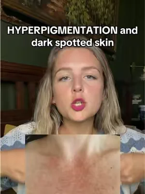 Replying to @676cnb hyperpigmentation and dark spots? This can be a game changer! . . . . . This is my experience, this is not medical advice and results may vary 