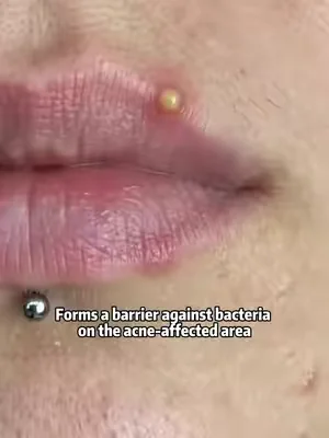#fyp #pimple #pimplepopping #SummerWins #DealsForYouDays 