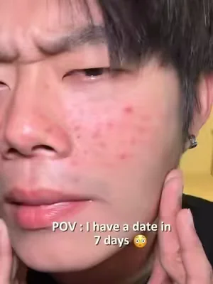 Hey guys, do you think I'll show up to the date in a good state?#DealsForYouDays #skincare #acnetreatment #acne #drleodryinglotion 