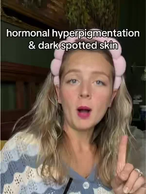 Replying to @user6885904560949 hormonal hyperpigmentation and sun damaged cow patties! This video is not medical advice and is about cosmetic concerns only. . . . . This is my experience, this is not medical advice and results may vary