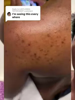Replying to @LADYLANDA|TIKTOKSHOP want to cleared your back acne of stubborn boils underarm this is the best there is #boils #cyst #acnetreatment 