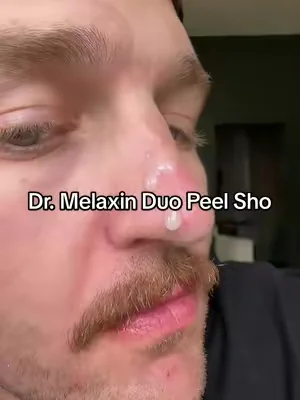 I can’t believe that actually worked 😳🤣🤣 #peelshot #blackhead #exfoliate #whitehead #dealsforyoudays 