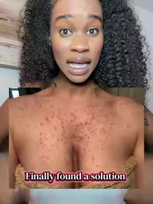 All it takes is finding the right ingredients to target your current skin issues ##dealsforyoudays##chemistatplay##boils##acnebreakouts
