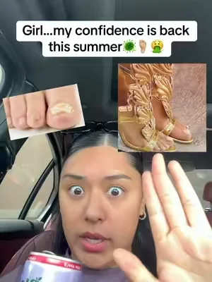 #fungus #nailfungus #toenailfungustreatment #toenail 