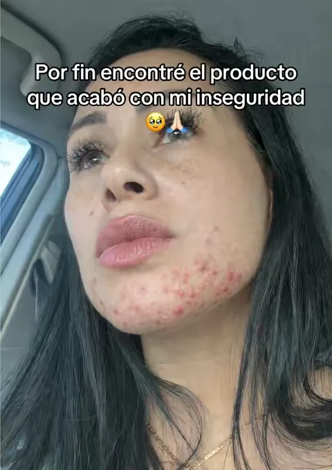 👆 la mejor recomendación que me dió mi mejor amiga  #GlowUp  #beautyhacks  #k20  #resultsmayvary  #paratiiiiiiiiiiiiiiiiiiiiiiiiiiiiiii  Disclaimer: los resultados pueden variar. 