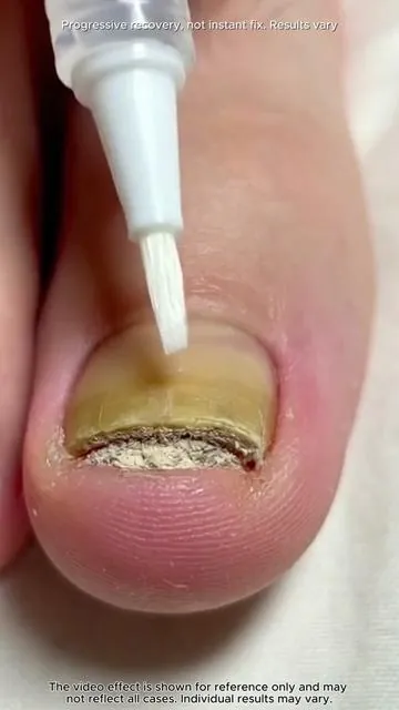 If this hassle bothers you too, you should definitely give this a try!
 #nailcare #toenails #nailtok #fyp #DealsforYouDays #SummerWins
