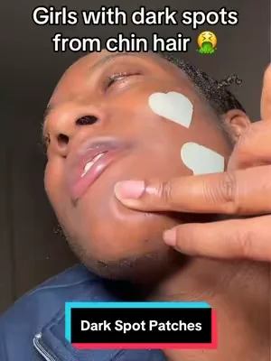 Dark spots under my chin is my biggest insecurity now these dark spot patches fixing that😀 #chinhairs #darkspots #hyperpigmentation #summeressentials #dealsforyoudays 