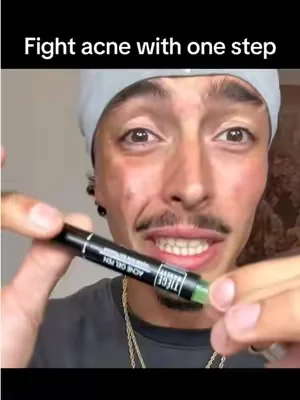 This little pen is literally my life savor for dealing with pimples @Tiege Hanley #tiegehanley #skincare #mensskincare #acne #pimples 