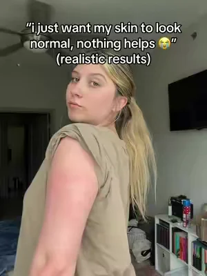 never thought i’d find something that works to clear my KP 🥲 #KP #strawberryskin #skintransformation 