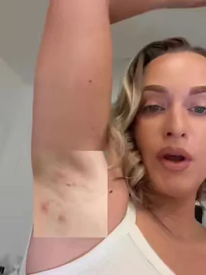 The fact acne and hs even exists 🤬 #hidradenitissuppurativaawareness #acneproneskin #cysticacne #tiktokshopcreatorpicks #salicylicacid 