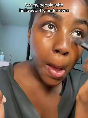 An actual game changer. #undereyes #hollowundereyes #eyelift 