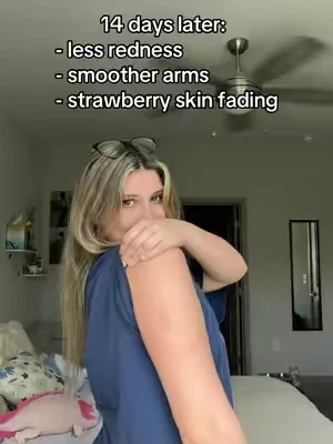 finally something’s working 🥲 #KP #strawberryskin #skintransformation 