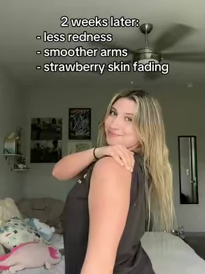 after years of avoiding tanks, i finally found something working to clear my KP 🥲 #KP #strawberryskin #skintransformation 