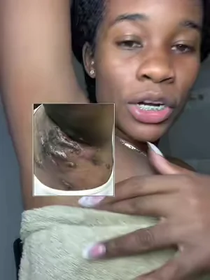 Buildup and inflames skin causes the boils that why you need to deep cleanse it #boils #cyst 