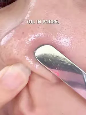 Blackheads, whiteheads, oil — this stick doesn't discriminate. It gets rid of all of them🌚#dealsforyoudays #glassskin #blackhead #beautytips #drleo 