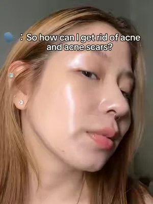 Acne + scars in the same sentence? Not anymore. This 4-piece lineup hits every single spot. 🎯 #weeklydeals #summerwins #skincare #acnetreatment #drleohonestreview 