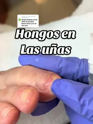 Respuesta a @anaedilia876  hongos en las Uñas de los pies . #DealsForYouDays  #hongos  #uñasdelospies  #uñas 