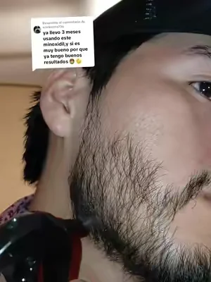 Respuesta a @erickcinto736  #viralllllll #minoxidilresult #minoxidil #paralabarba #paraelcabello 